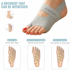 Hyggear Bunion Corrector (Big Toe, Halux Valgus) - 22979067572